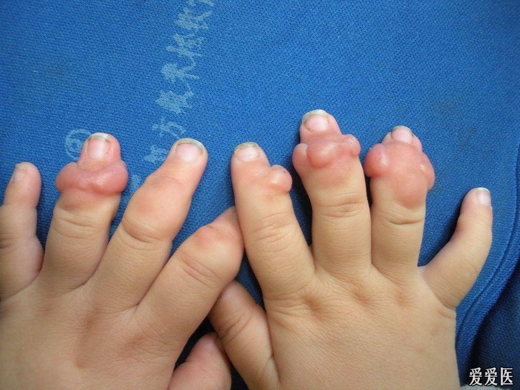 皮肤版"u盘奖励典型病例011:婴儿指趾纤维瘤病"