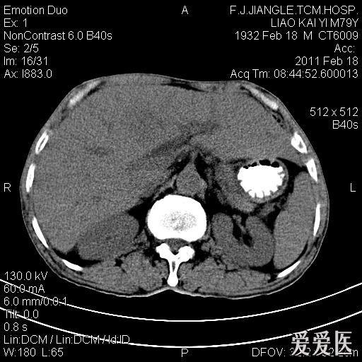 一例确诊的肝脓肿ct平扫增强