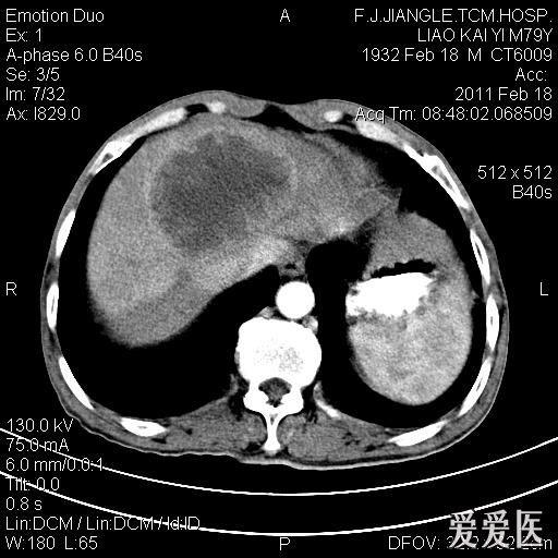 一例确诊的肝脓肿,ct平扫 增强