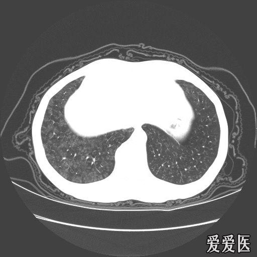经典肺部病变ct