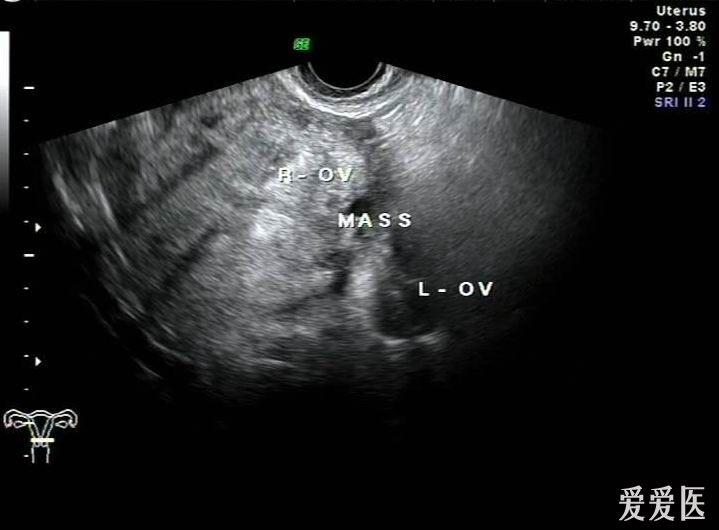 定位不准确的盆腔实性肿块——zengerya四十贴 - 超声