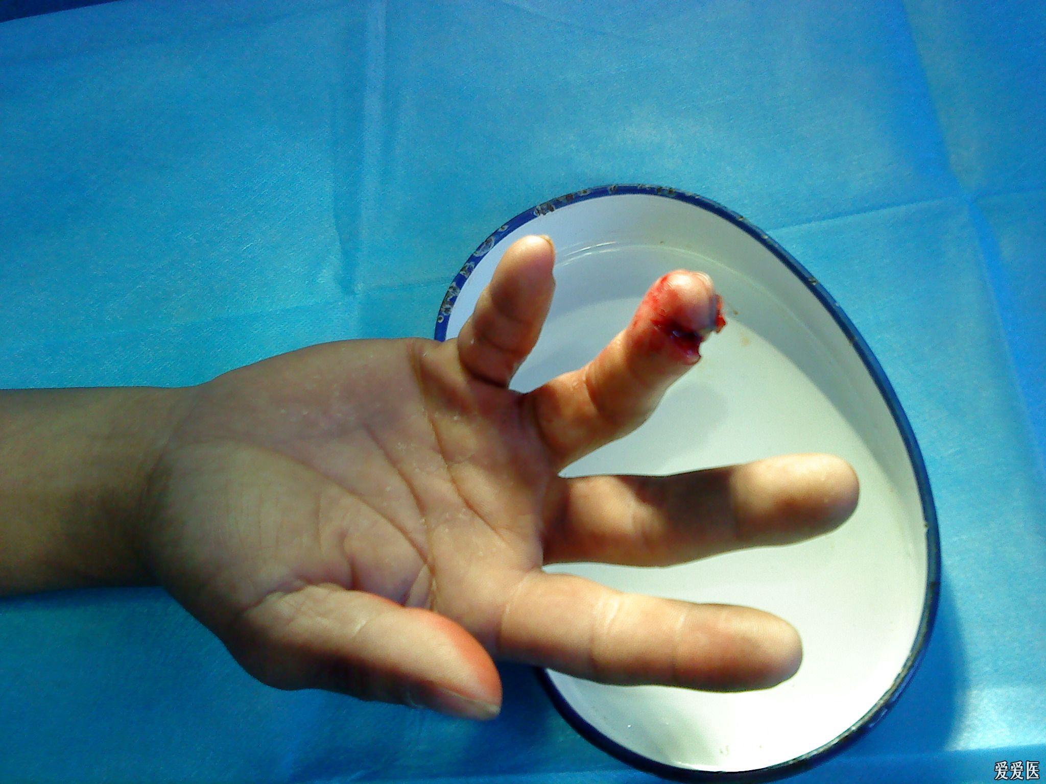 右手环指末节开放性骨折