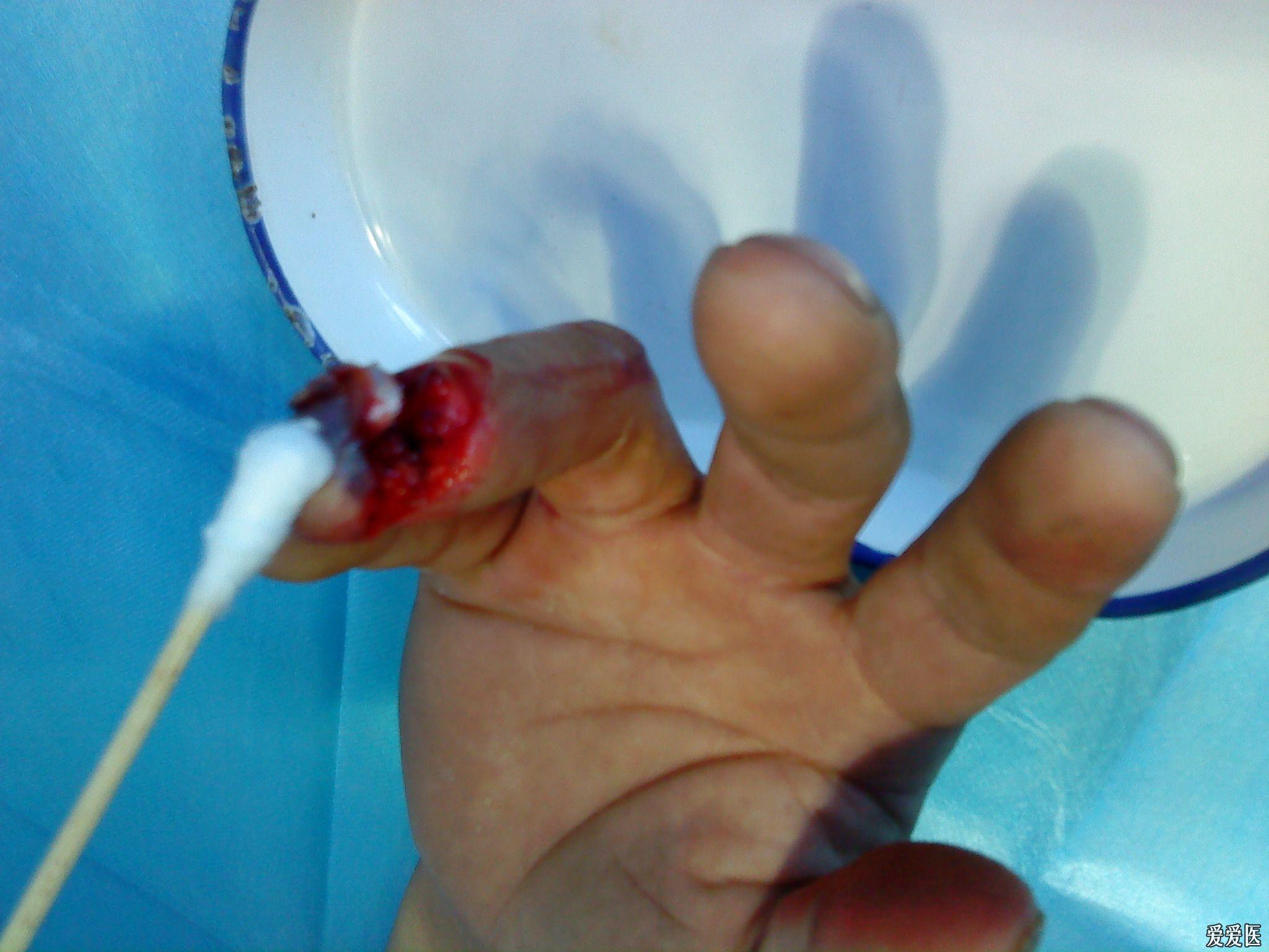 69 骨科与显微外科专业讨论版 69 右手环指末节开放性骨折   马上