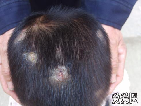 小儿头部皮肤病