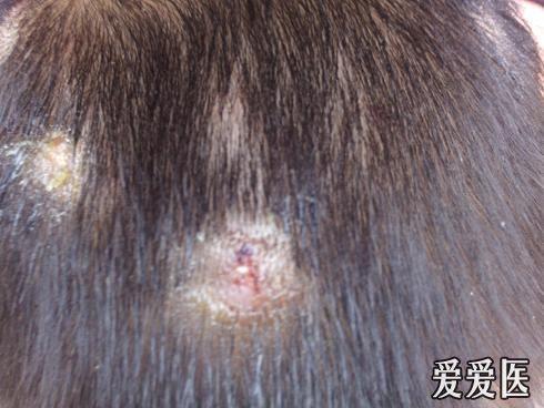 小儿头部皮肤病
