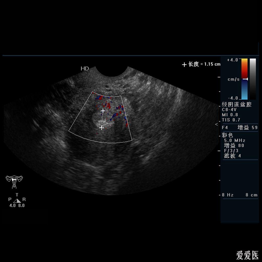 这个子宫内膜考虑什么 超声医学讨论版 爱爱医医学论坛