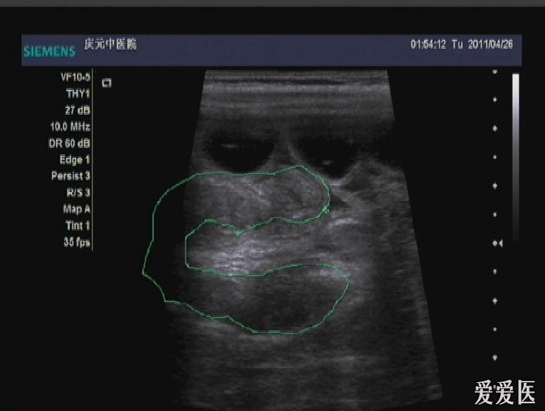 肠套叠 - 超声医学讨论版 - 爱爱医医学论坛