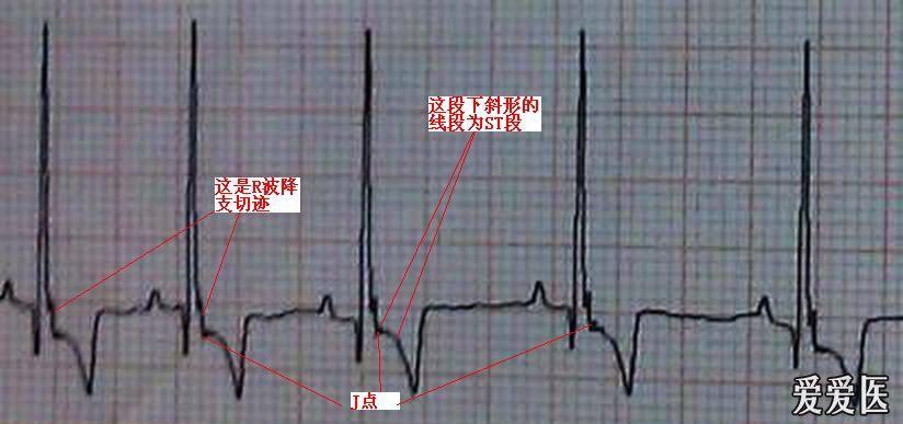 求教各位前辈:这张心电图的st段怎么取?