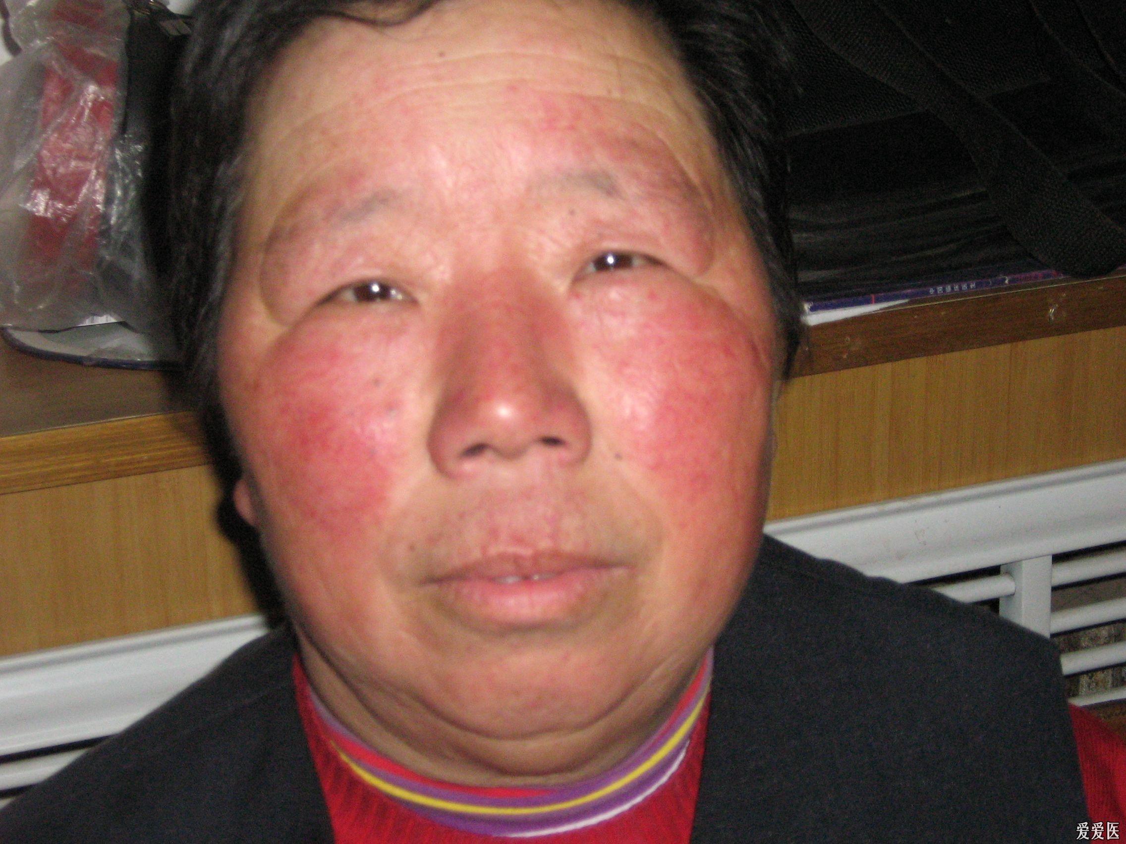 某女 60岁 面部皮疹数年  时轻时重 无季节性 和见阳光无关 重时流水