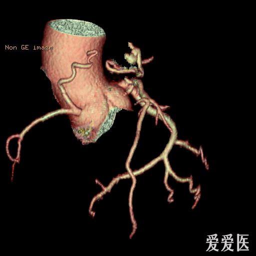 冠状动脉肺动脉瘘形成