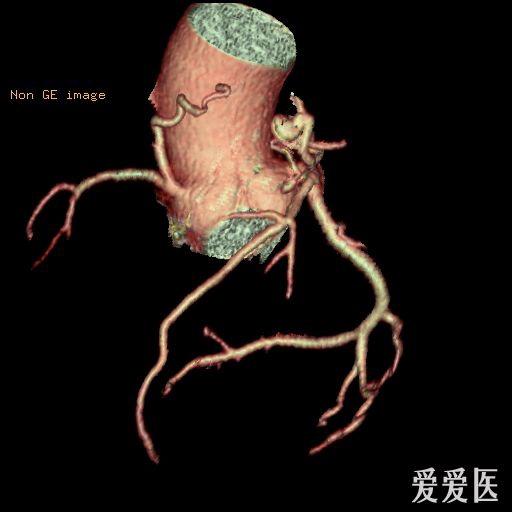 冠状动脉肺动脉瘘形成