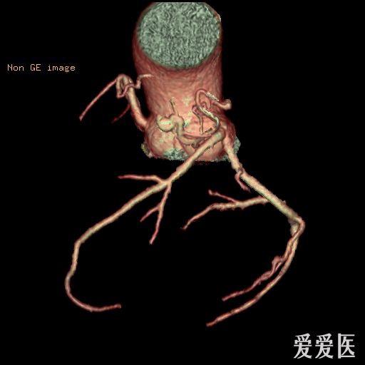 冠状动脉肺动脉瘘形成