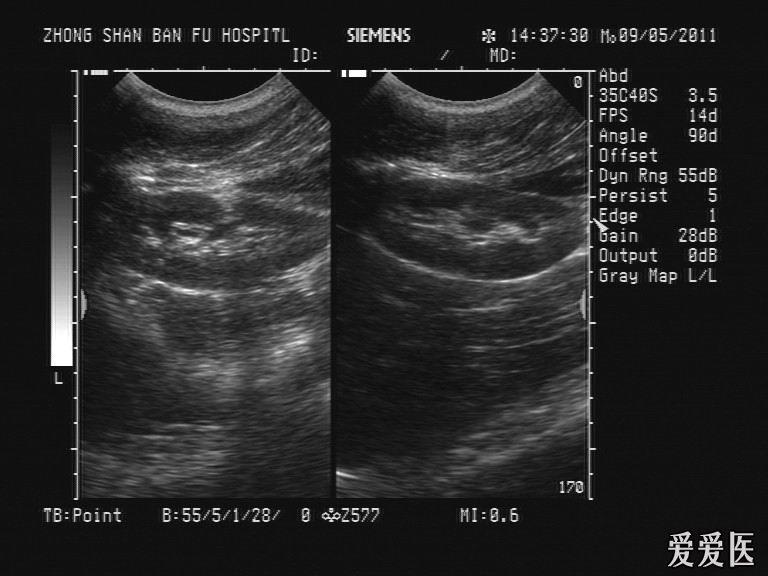 请问是腺性膀胱炎吗 - 超声医学讨论版 - 爱爱医医学