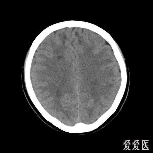 头颅ct检查,多发低密度区,请教大家!