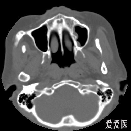 鼻咽部ct