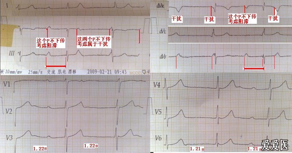 于 2011-5-18 09:03 编辑   我的看法:首先这幅图左右手反接