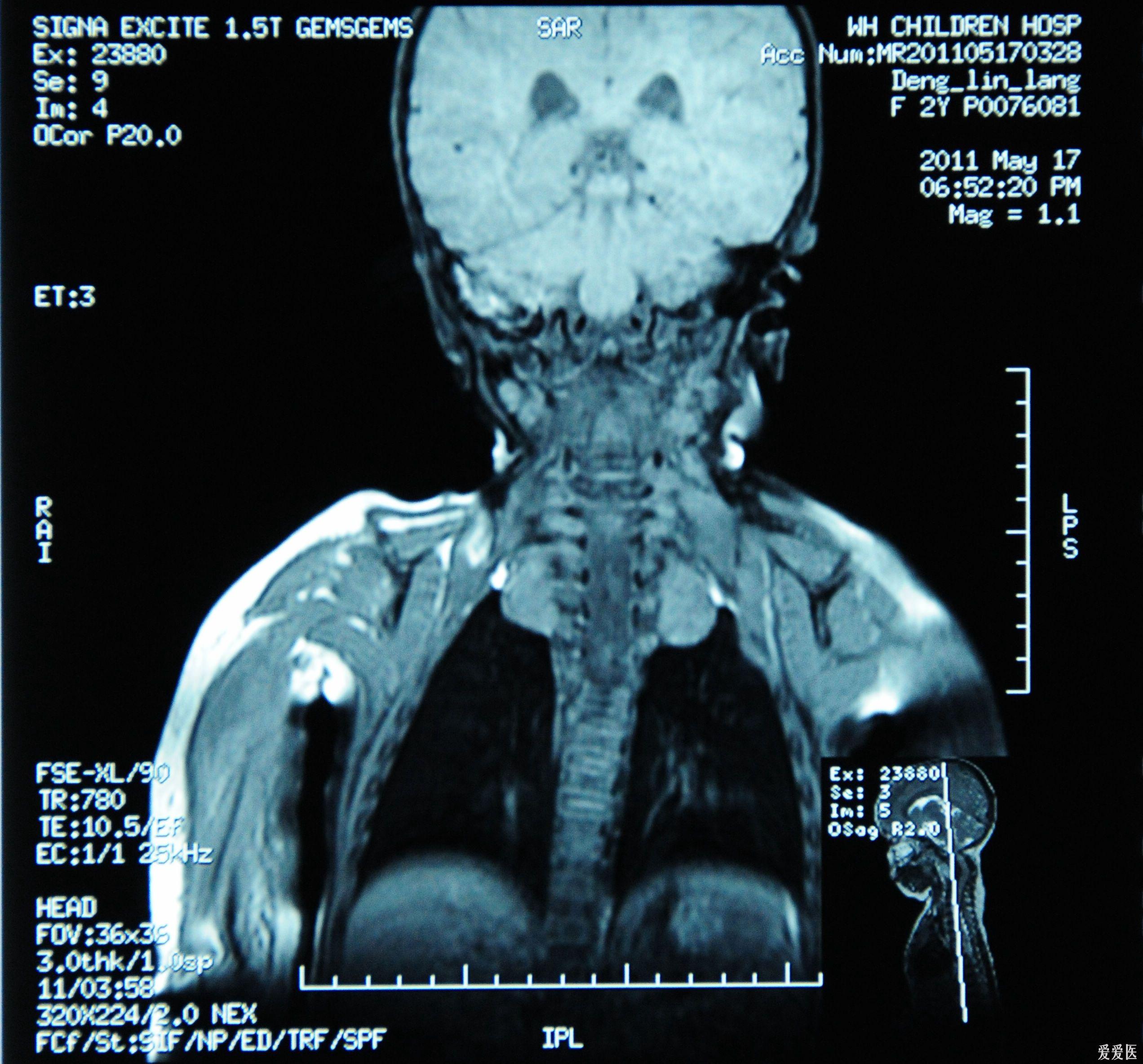 肿瘤信号是长t1长t2_肾上长肿瘤是恶性的吗_耳朵后面长了个硬包是肿瘤吗？