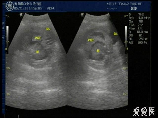 前列腺占位 超声医学讨论版 爱爱医医学论坛