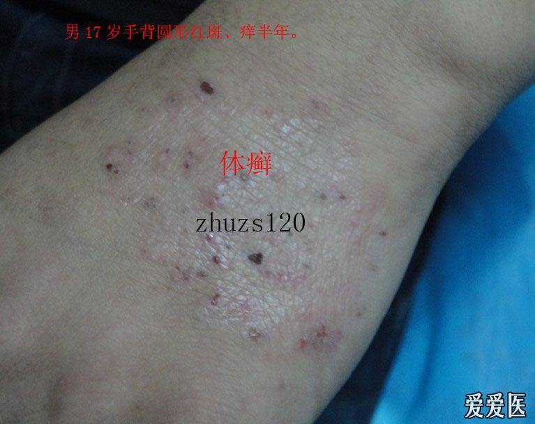 [皮肤病] 体癣