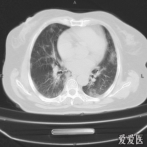 两肺斑片状影