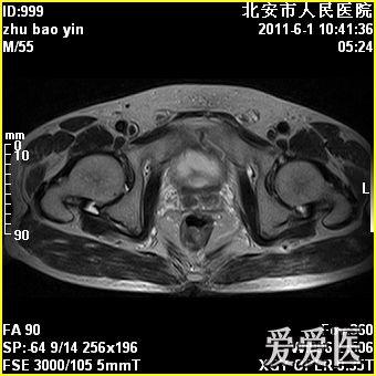 膝关节积液 和髋关节积液如何治疗比较好呢(内附磁共振图像)