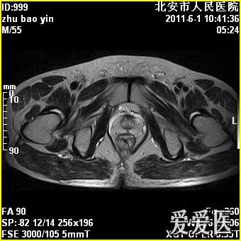 膝关节积液 和髋关节积液如何治疗比较好呢(内附磁共振图像)