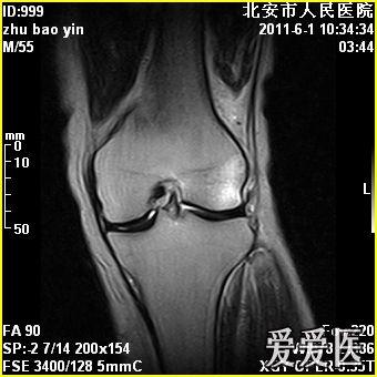 膝关节积液 和髋关节积液如何治疗比较好呢(内附磁共振图像)