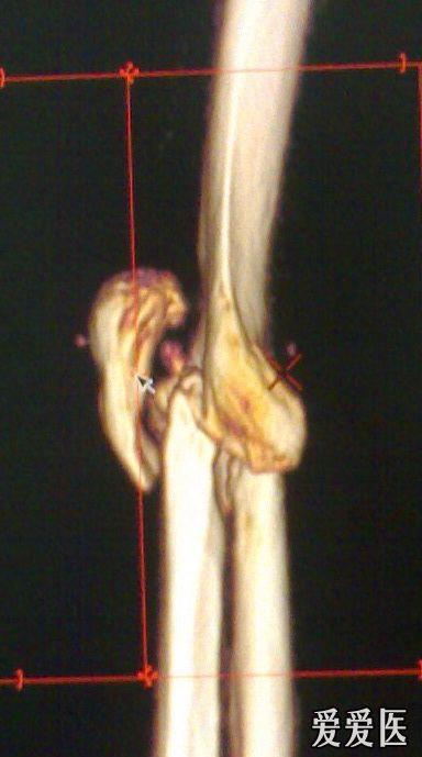 ct关节骨质破坏显著,周围无明显软组织肿块.