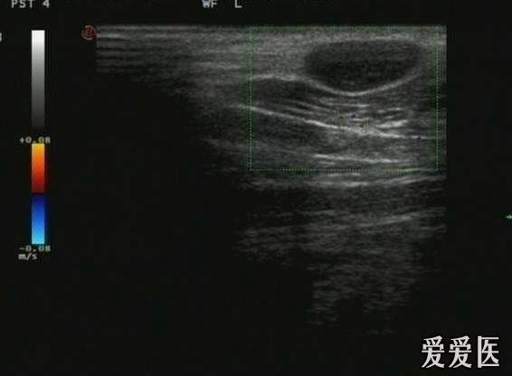 发一个颈部皮下异常回声的病例 - 超声医学讨论版 - 爱爱医医学论坛