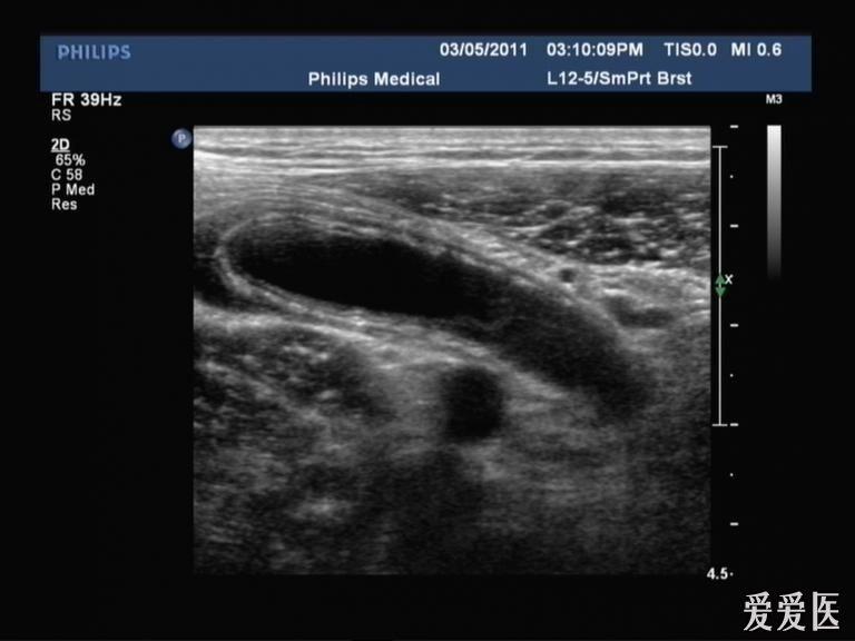 阑尾炎 - 超声医学讨论版 - 爱爱医医学论坛