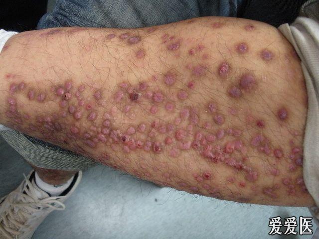典型病例:是结节性痒疹吗,公布结果:痒疹型营养不良性