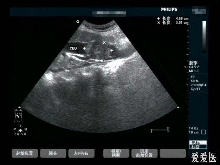胆总管占位(肠型腺癌) - 超声医学讨论版 - 爱爱医
