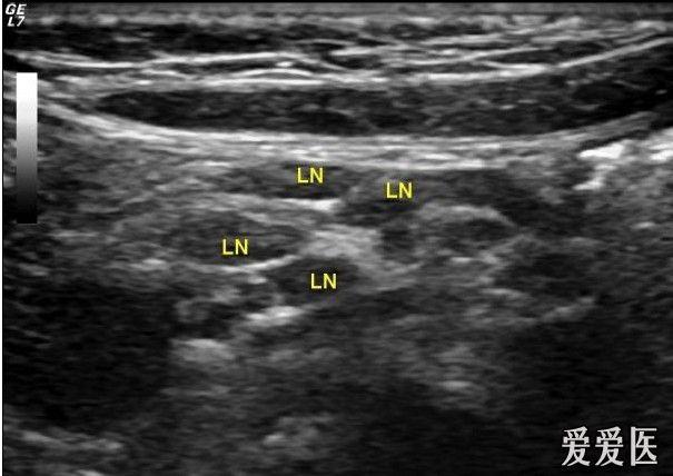 肠系膜淋巴结b超表现 - 超声医学讨论版 - 爱爱医医学