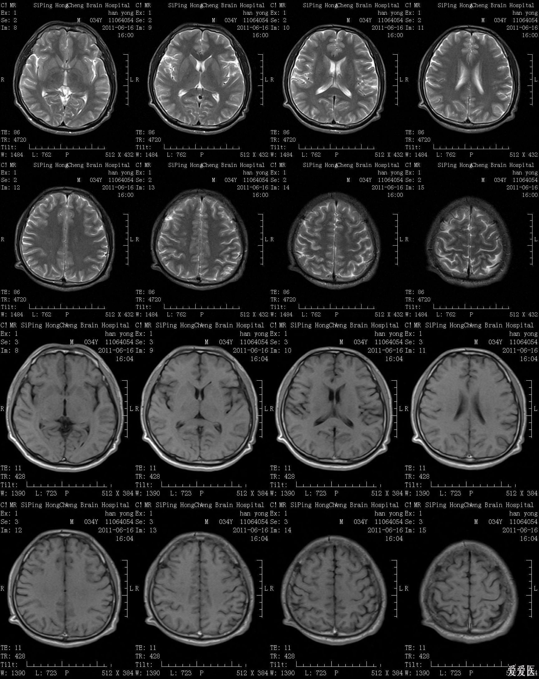 一、颅脑正常CT解剖-CT读片指南-医学