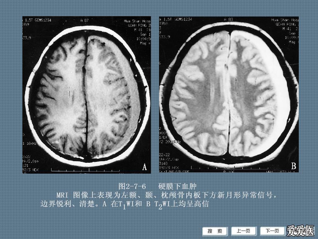 硬膜下血肿 .jpg