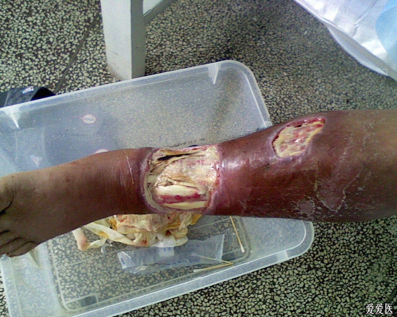 蛇咬伤导致左胫前皮肤组织缺损感染