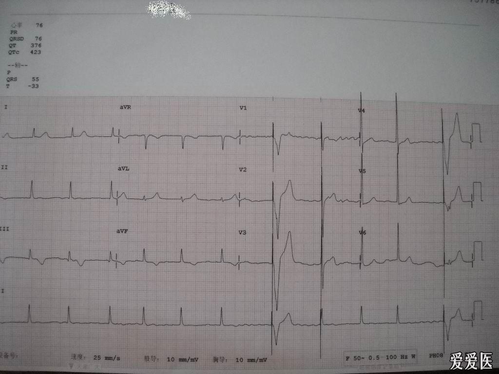 请山羊老师看一下起搏器的心电图该怎么下诊断,谢谢!