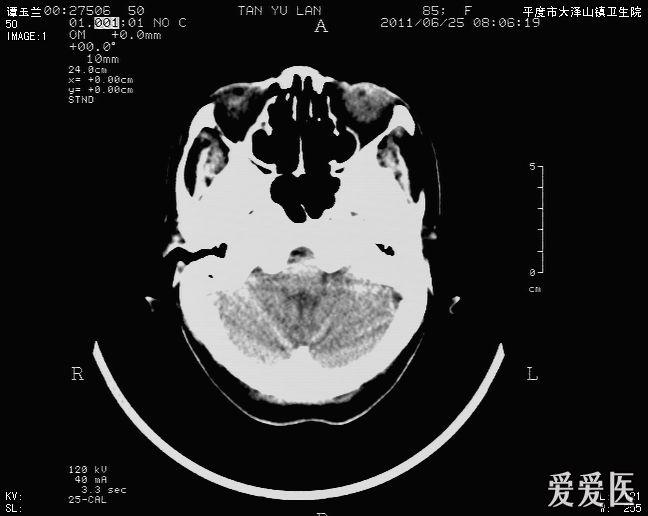 头颅ct,脑积水?