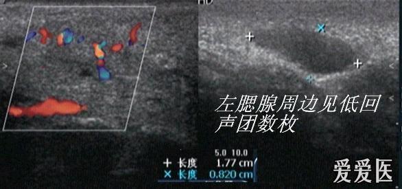 腮腺导管结石并感染