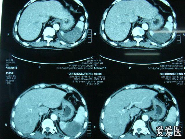 脾梗塞ct图像