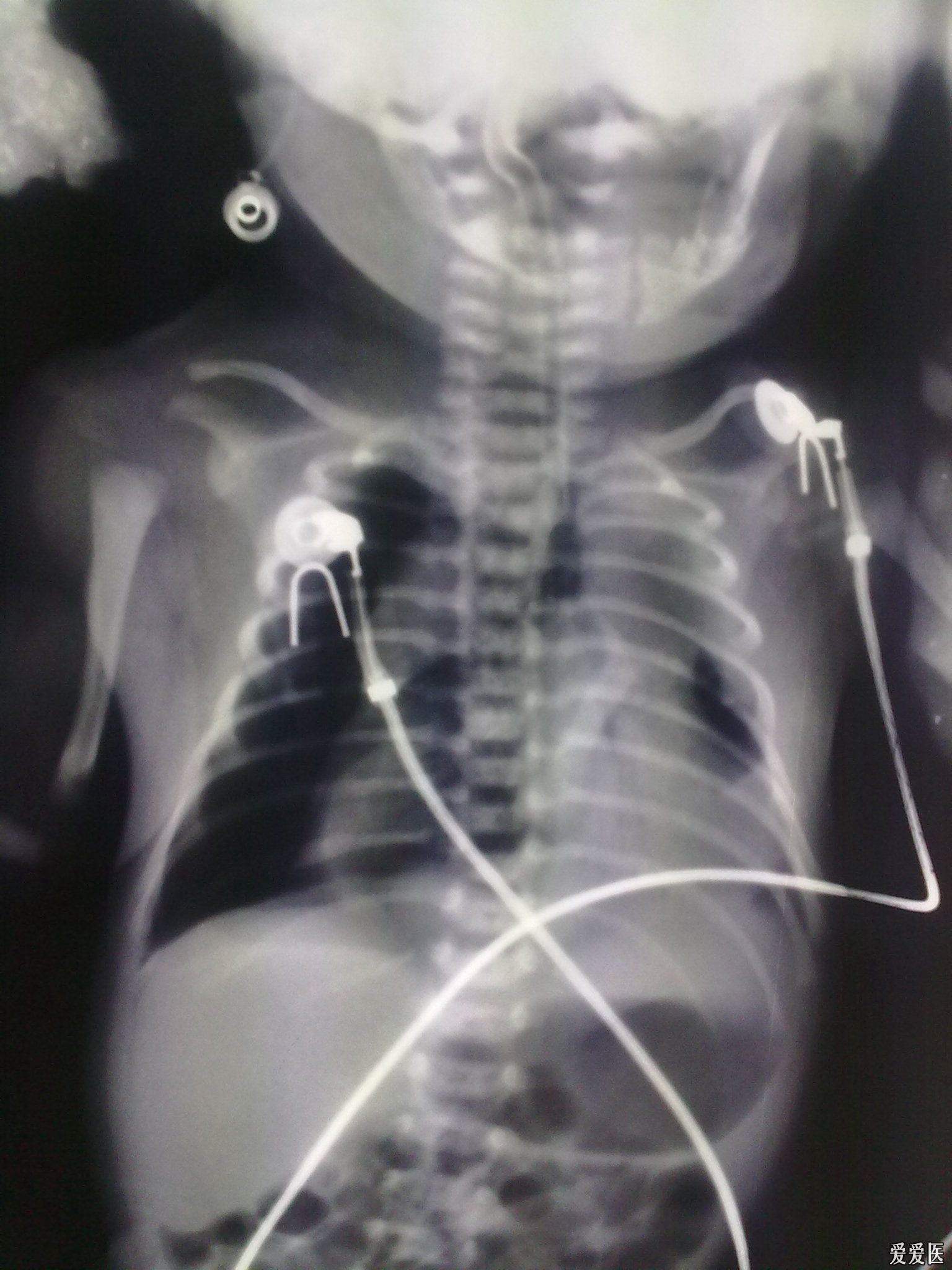 警惕新生儿气胸pneumothorax