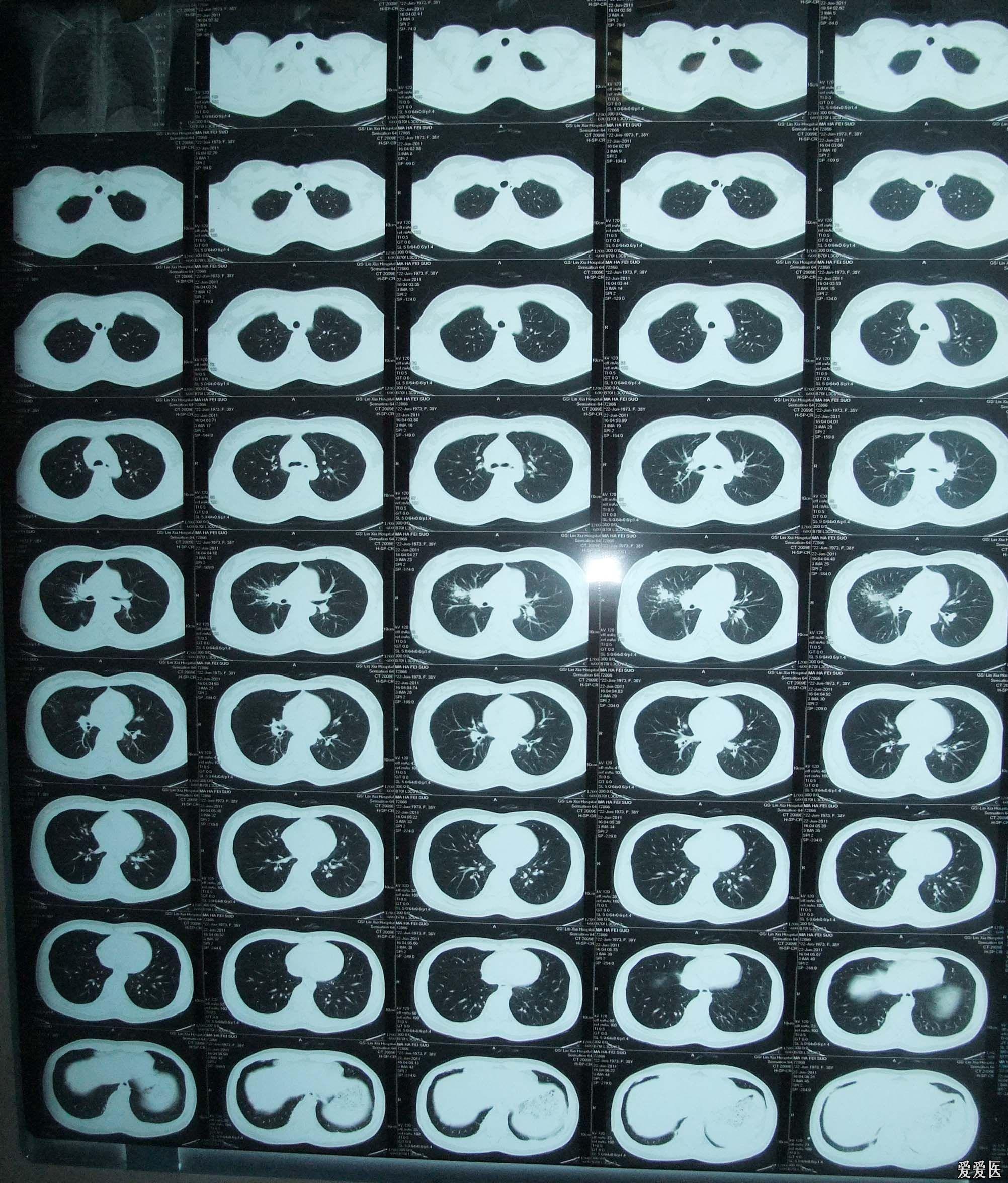 肺窗