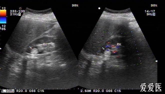 肾错构瘤2例. - 超声医学讨论版 - 爱爱医医学论坛