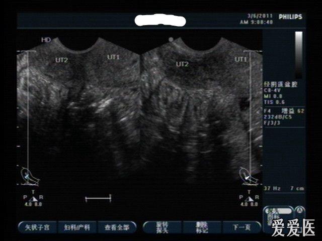 双子宫or残角子宫? - 超声医学讨论版 - 爱爱医医学