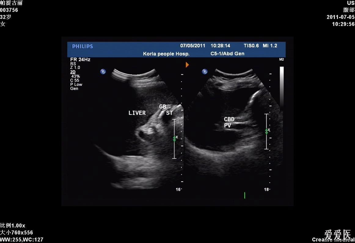 结石性胰腺炎合并胰腺假性囊肿形成 - 超声医学讨论版 - 爱爱医医学