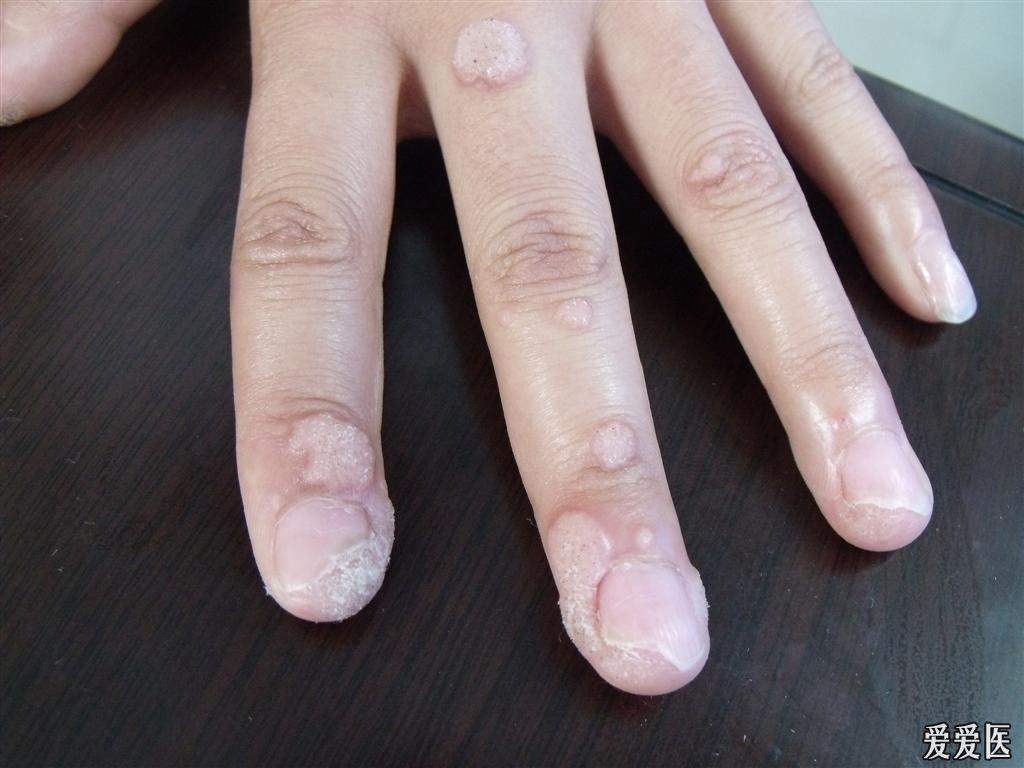多发性指端寻常疣和甲周疣