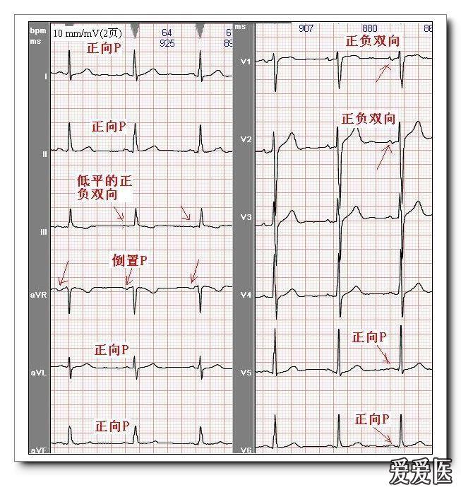 窦性p波的标准 1 ) avr导联p波倒置.2)i,ii,avf,v4-v6导联p波直立.