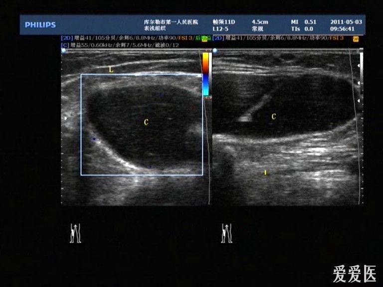 腘窝囊肿 - 超声医学讨论版 - 爱爱医医学论坛