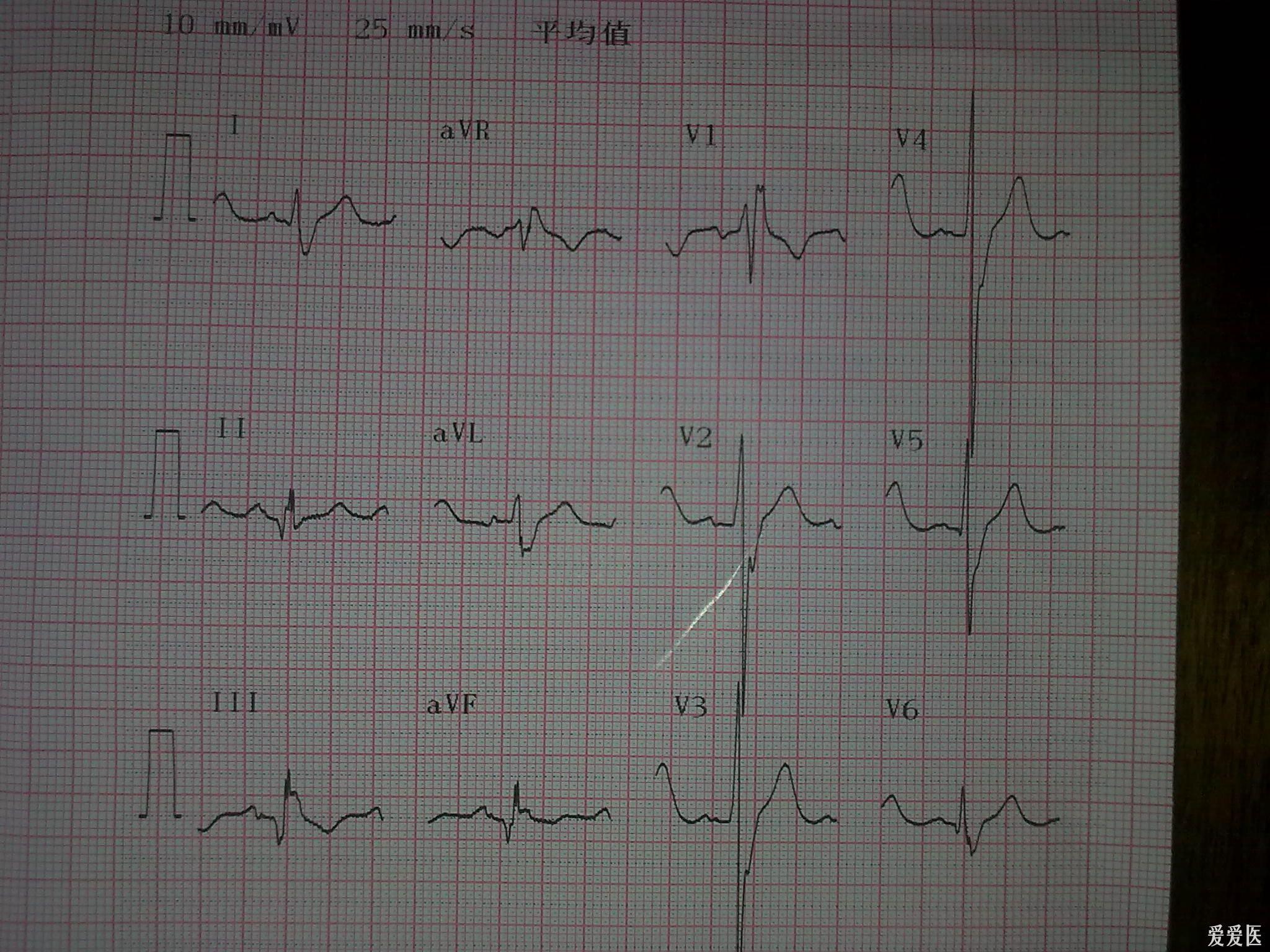 69 心电图脑电图专业讨论版 69 下壁出现q波,胸导连st压低,是心梗