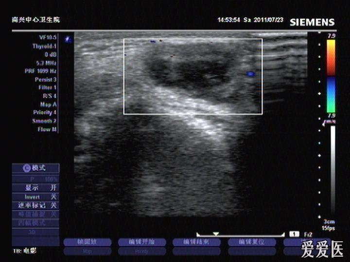 甲状舌骨囊肿? - 超声医学讨论版 - 爱爱医医学论坛